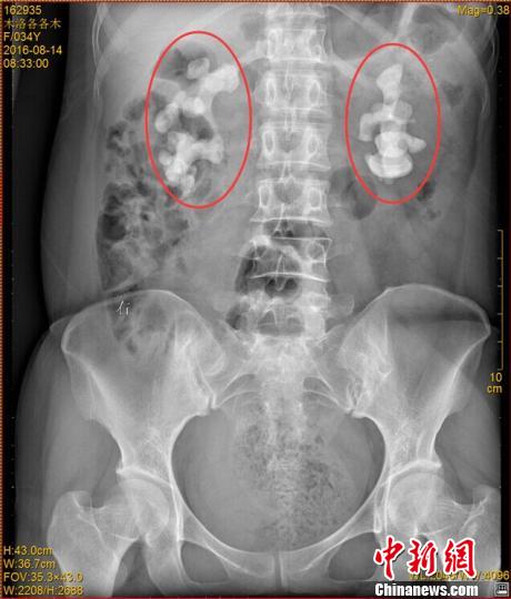 四川一女子喝生水30餘年雙腎長(zhǎng)10釐米巨型結(jié)石